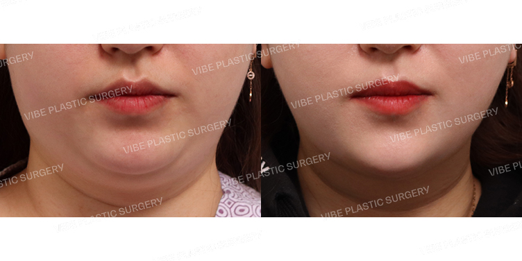 #초음파지방흡입(이중턱,턱라인) #턱끝필러