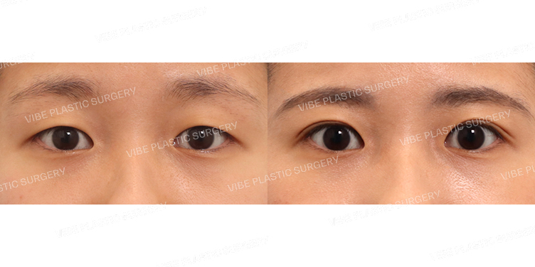 #부분절개쌍꺼풀