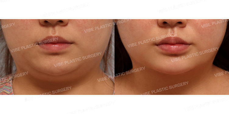 #초음파지방흡입(이중턱,턱라인)