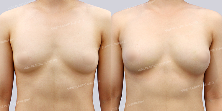 #지방이식(가슴)