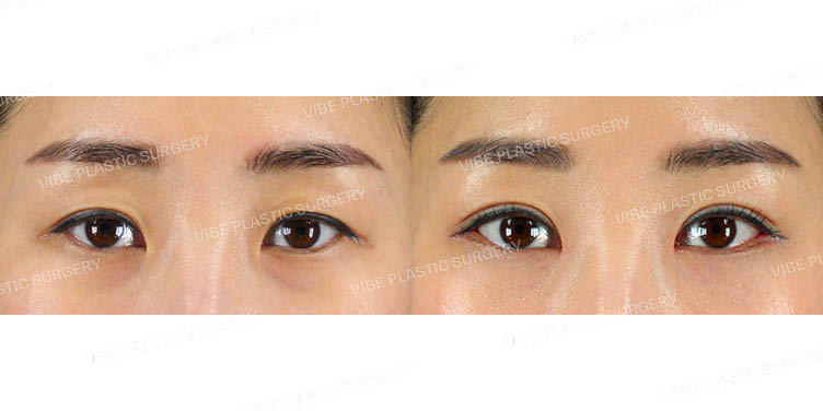 #비절개눈매교정 #앞트임 #뒤트임