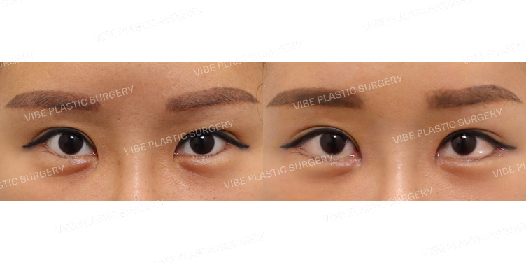 #뒤트임 #밑트임