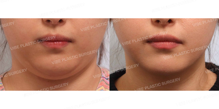 #초음파지방흡입(이중턱,턱라인)