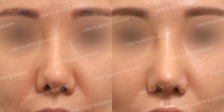 #짧은코 #복코 #비공내리기(재수술)