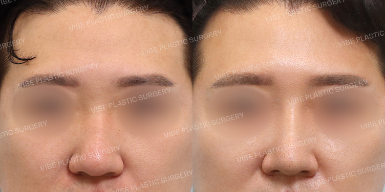 #남자코 #복코 #긴코 #매부리코 #코끝 #이마거상술