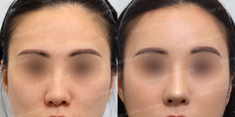 #매부리코 #복코 #비중격연장이식 #비순각교정 #풀페이스지방이식