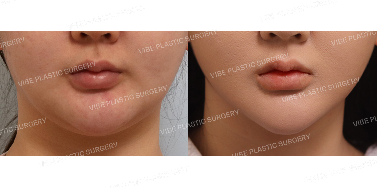 #초음파지방흡입(이중턱,턱라인,앞볼) #실루엣리프팅(심술보)