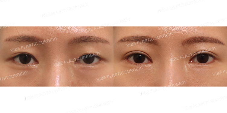 #절개쌍꺼풀(3번째재수술)