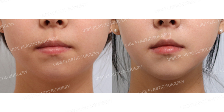 #초음파지방흡입(이중턱,턱라인)