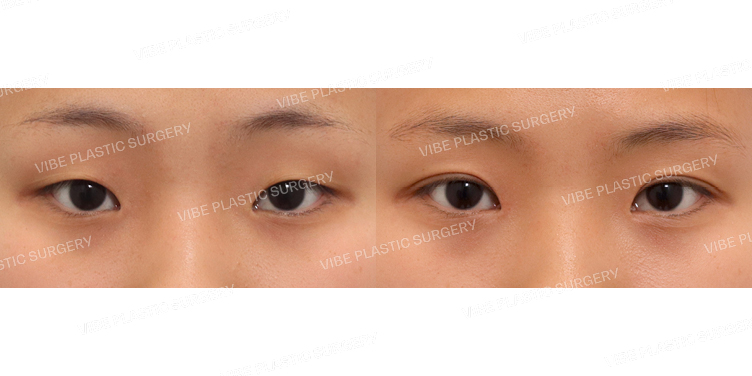 #절개쌍꺼풀 #앞트임