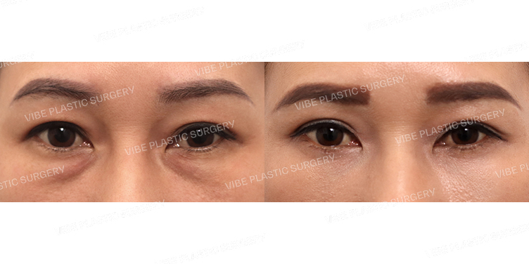 #상안검 #눈밑지방재배치