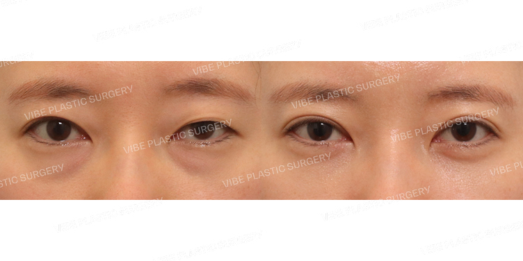 #절개쌍꺼풀(재수술) #눈밑지방재배치