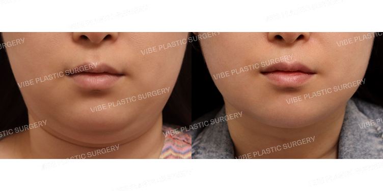 #초음파지방흡입(이중턱,턱라인)