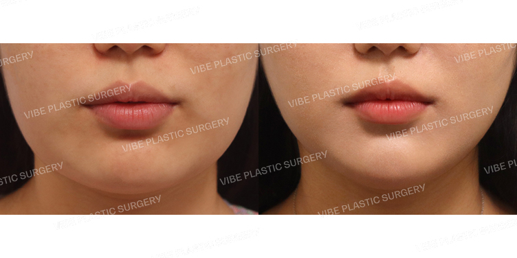 #초음파지방흡입(이중턱,턱라인)