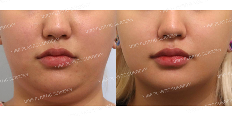 #초음파지방흡입(옆광대,이중턱,턱라인)