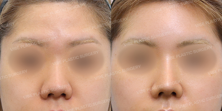 #실리콘보형물 #코끝 #복코 #지방이식