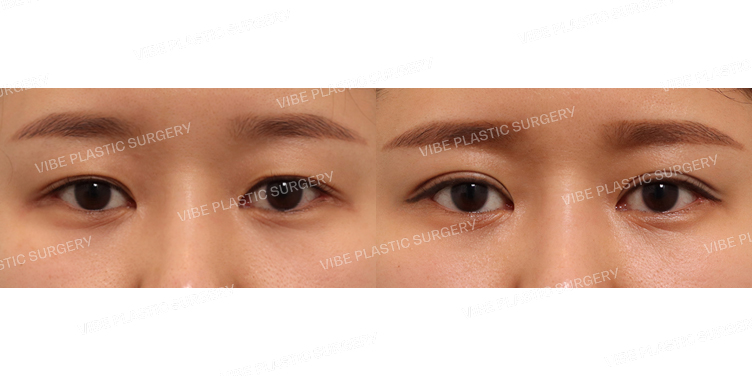 #절개쌍꺼풀(재수술)