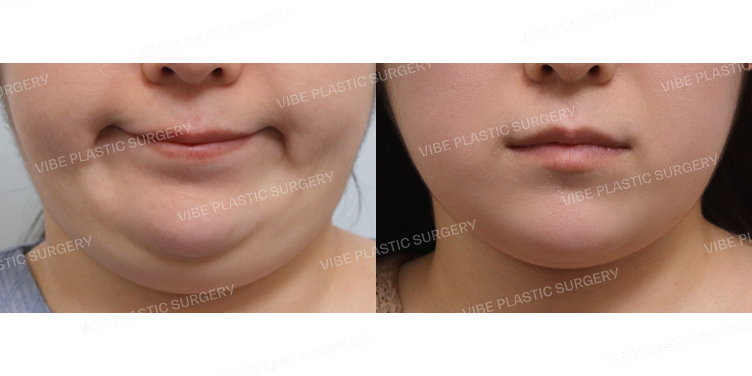 #초음파지방흡입(이중턱,턱라인,앞볼) #실리프팅 #턱끝필러 #슈링크