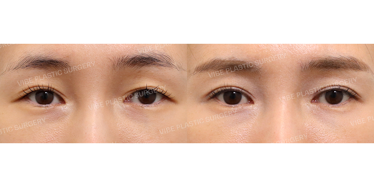 #눈재수술 #절개눈매교정