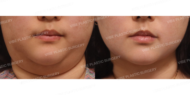 #초음파지방흡입(이중턱,턱라인) #심부볼지방제거