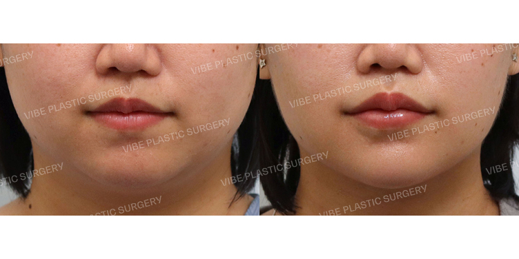 #초음파지방흡입(리포사운드) #이중턱근육묶기(목리프팅)