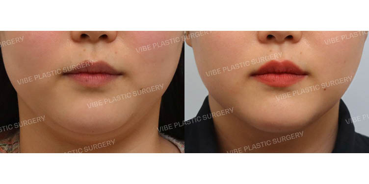 #초음파지방흡입(이중턱,턱라인)