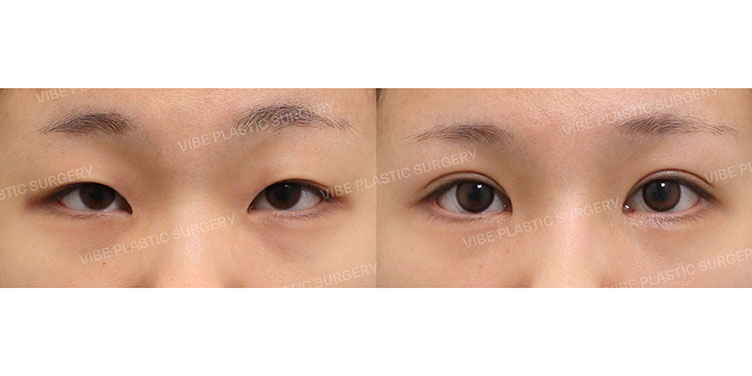 #부분절개눈매교정 #앞트임