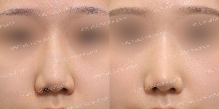 #무보형물 #매부리코 #복코 #긴코