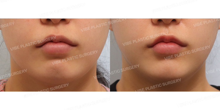 #초음파지방흡입(이중턱,턱라인)