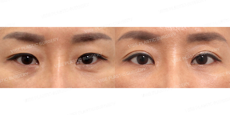 #상안검(재수술) #뒤밑트임