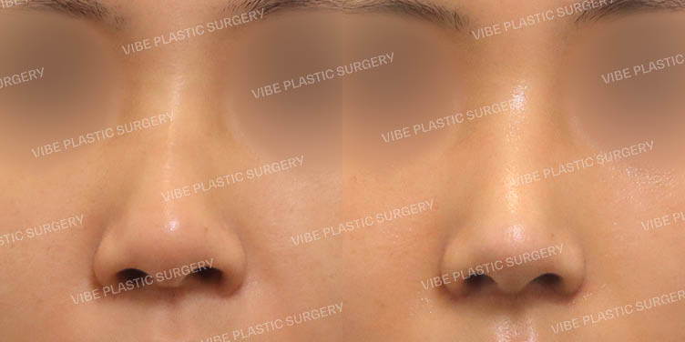 #무보형물 #매부리코 #복코