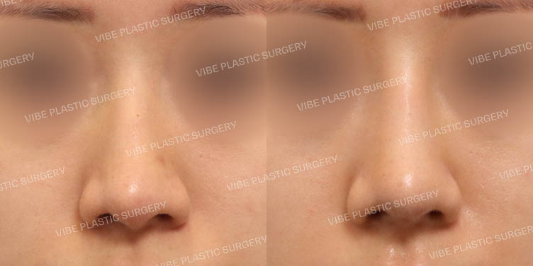 #재수술 #매부리코 #휜코 #기능/건강코