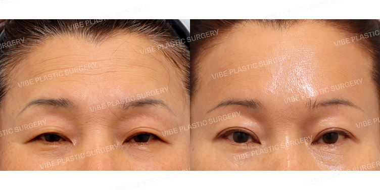 #내시경이마거상 #눈썹밑거상 #자연유착