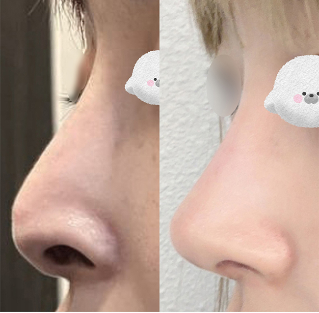 코재수술 바이브로 선택 잘한듯