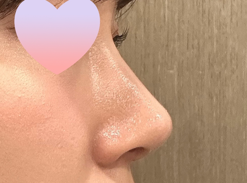 무보형물 코성형 3갤차!!