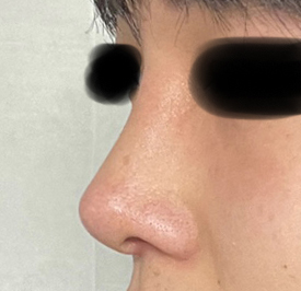 코수술 결과 대만족!강추!