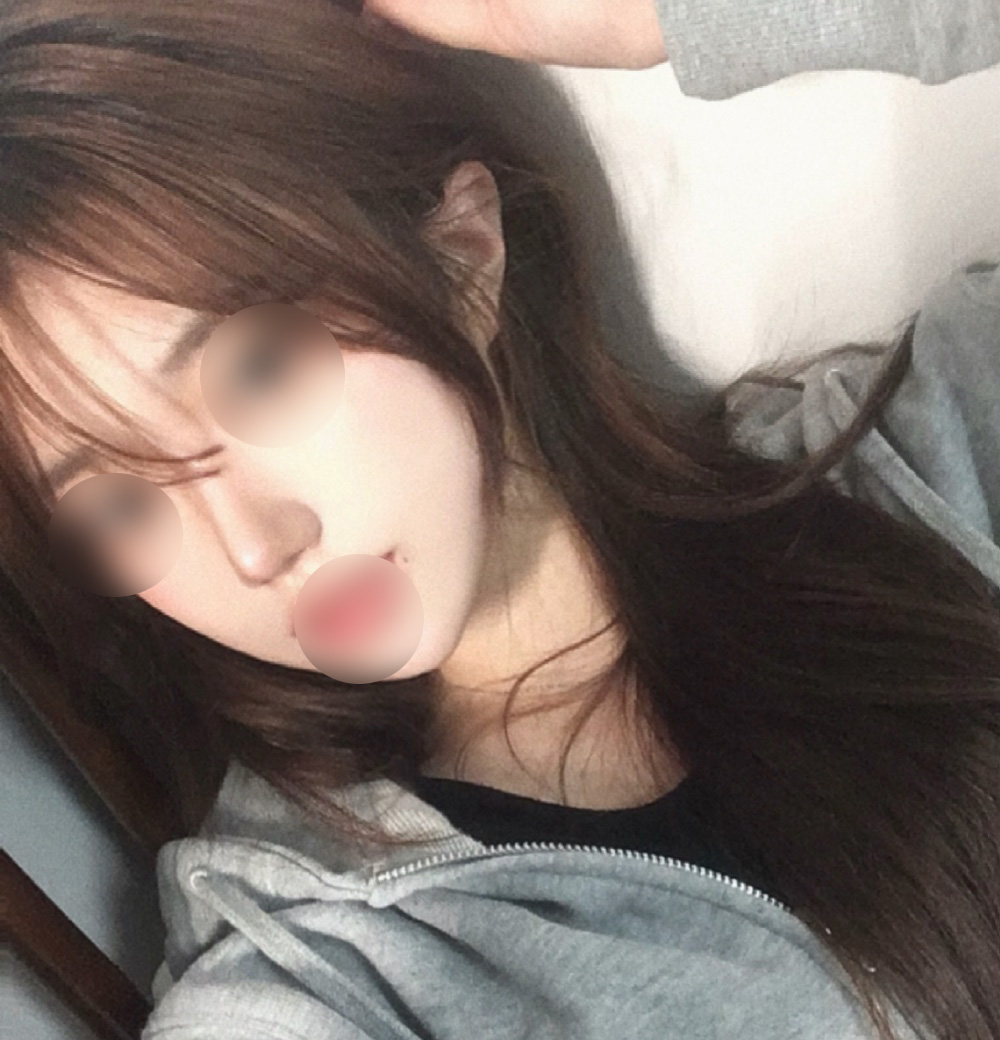 원하는 모양대로 코수술해주셨어요ㅎ.ㅎ