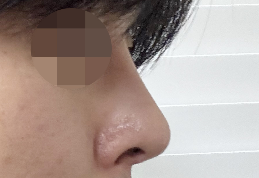 코3번째수술, 바이브에서 수술한 후기