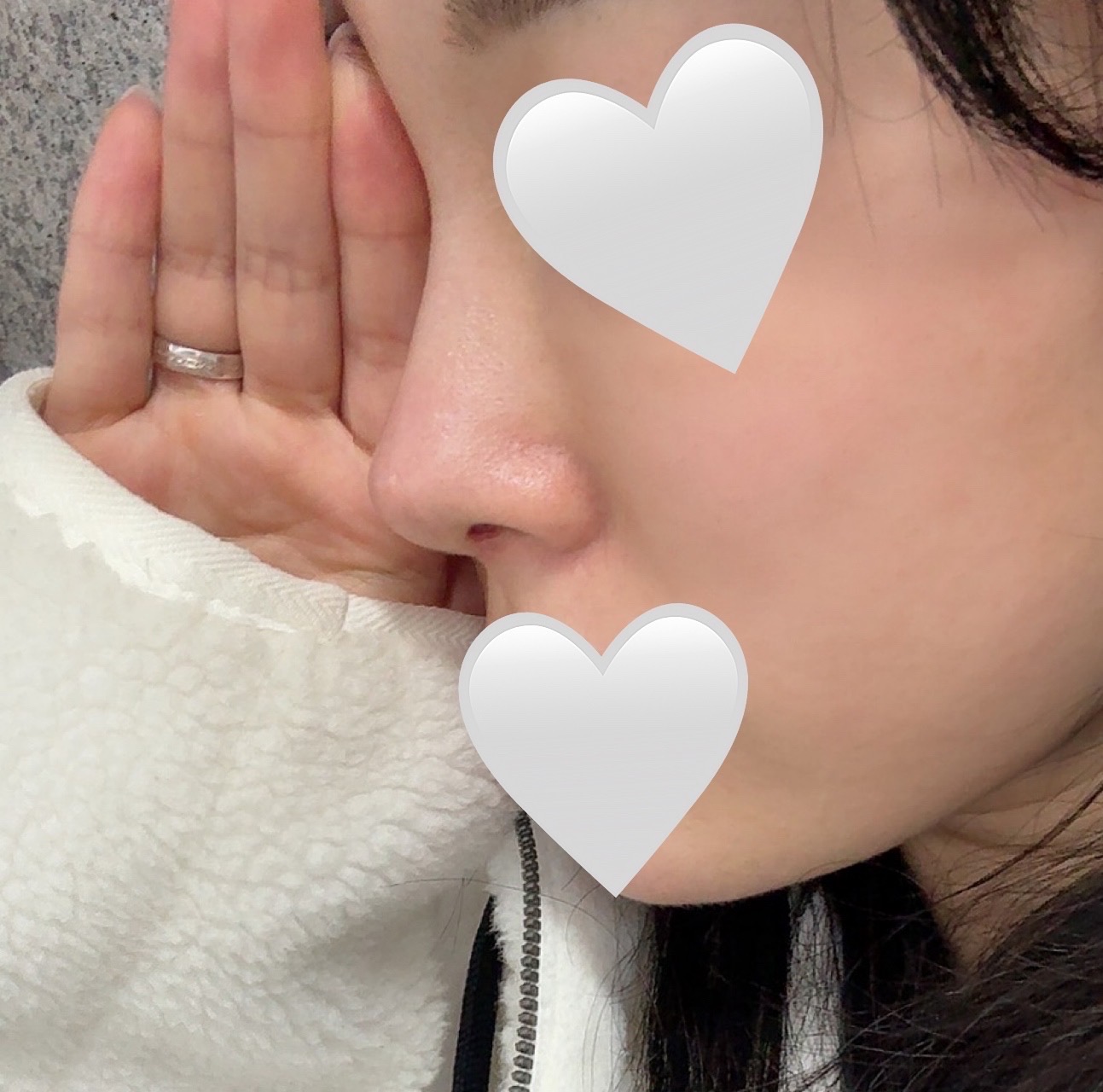 바이브 코수술 5개월차됐슴다