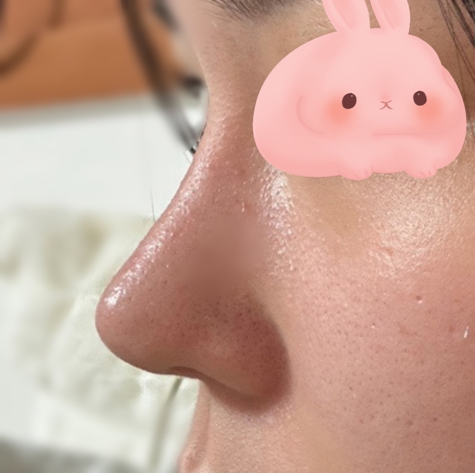 코랑 이중턱지흡 강추강추