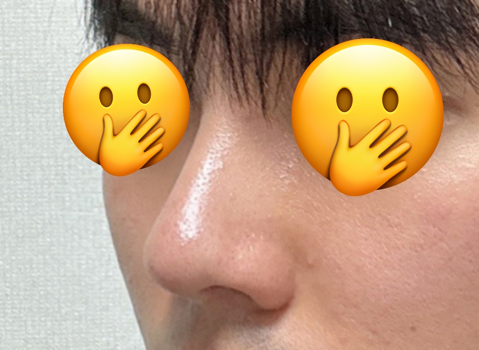 코수술 잘했구나 싶어요