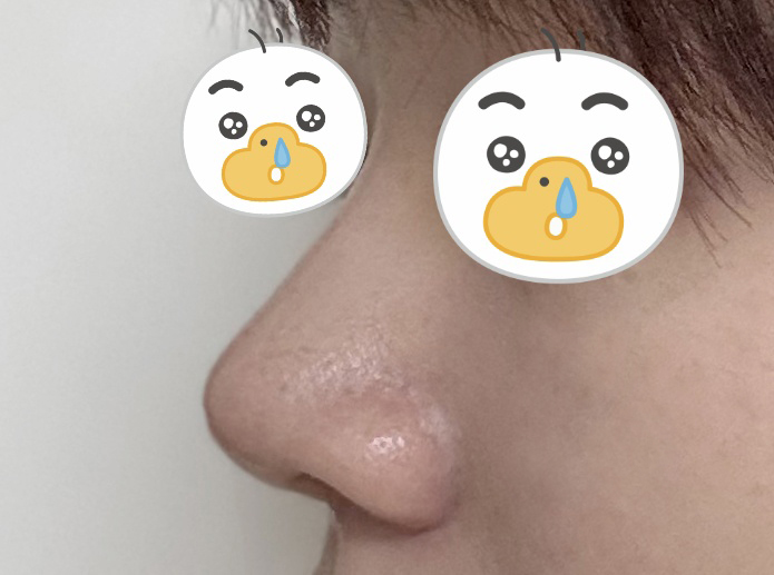 무보형물 코성형 너무 만조옥!