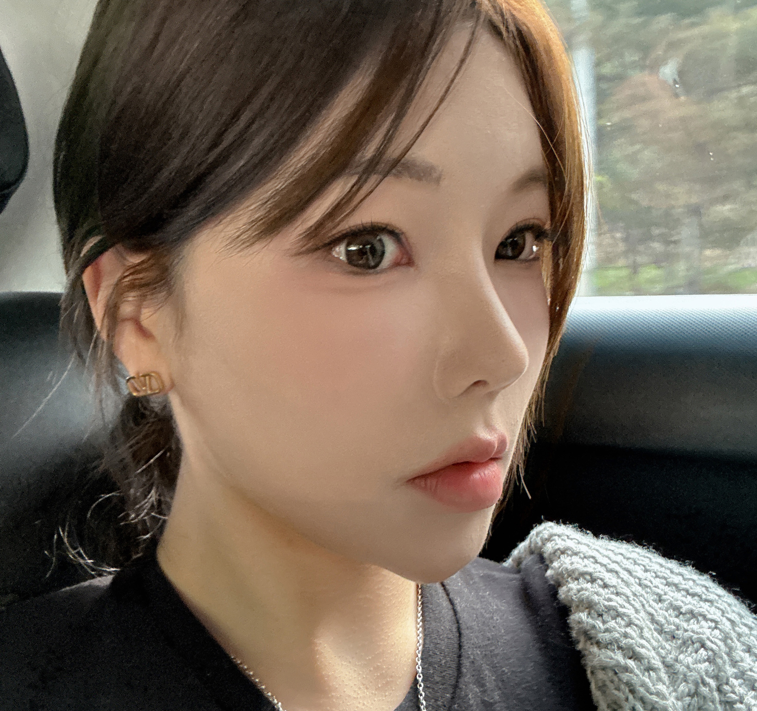 내시경이마거상/절개쌀꺼풀/코재수술 8개월차