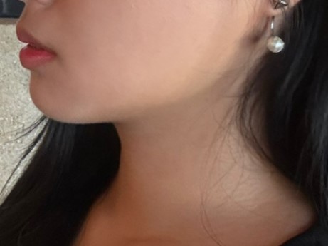 수술 후 너무 만족스러워요 !