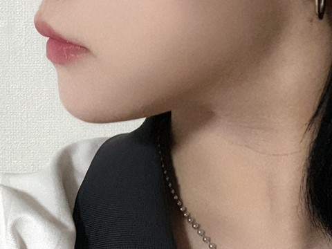 고민이었던 이중턱이 많이 개선 되어서 만족해요 ㅎㅎ