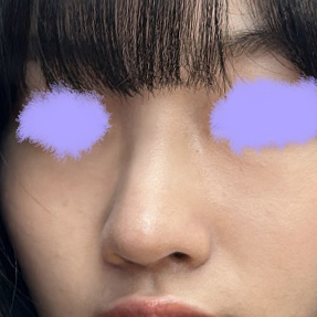 무보형물 6개월차