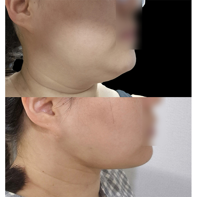 수술전후측면_1_.jpg