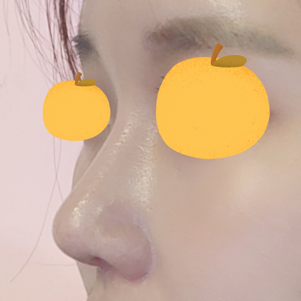 코수술 한지 벌써 3개월 차네요!