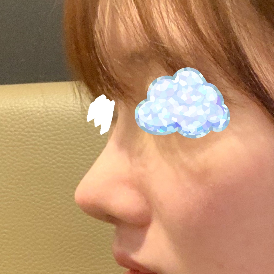 무보형물 코수술 제스타일 잘 찾았어요