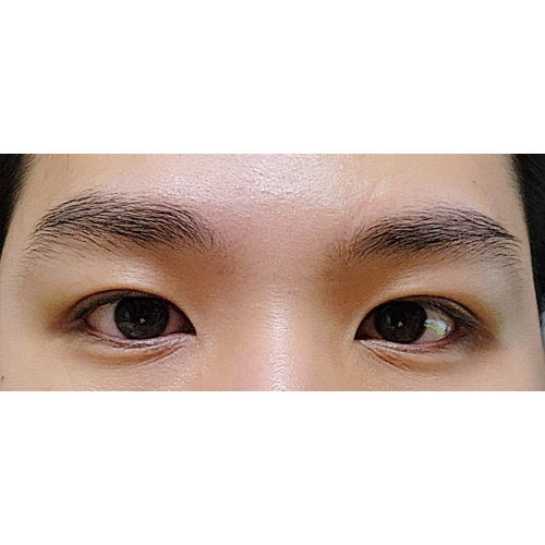 절개눈매교정 유영문 원장님 감사합니다!